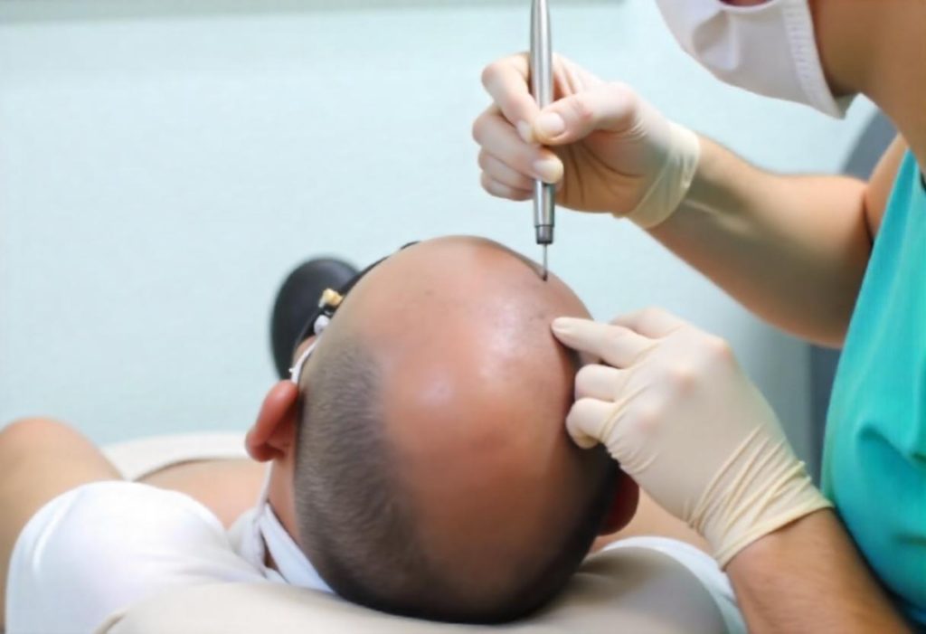 fue-hair-transplant