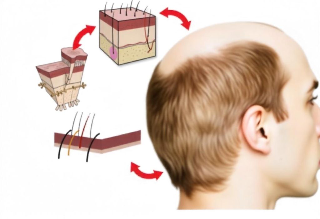 fut-hair-transplant
