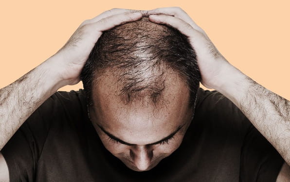 When Should You Consider a Hair Transplant When Should You Consider a Hair Transplant